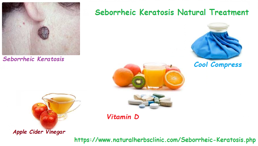 Get Rid From Seborrheic Keratosis With Natural Treatment Herbs Images